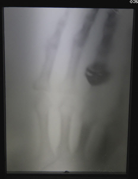 X-ray photo of hand of Wilhelm Conrad Röntgen's wife (Dec. 22, 1895) at Deutsches Museum. Munich, Germany.