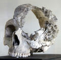 Diseased skull in Dr. William Hunter's medical specimen collection at Hunterian Museum. Glasgow, Scotland.